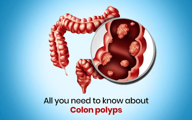 All you need to know about Colon polyps